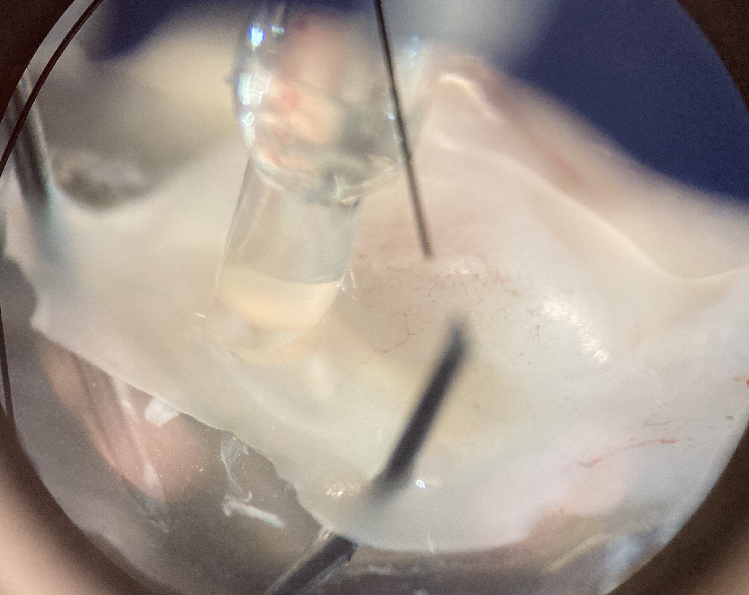Close-up view of a surgical procedure, showing fine instruments working on translucent tissue under magnification.